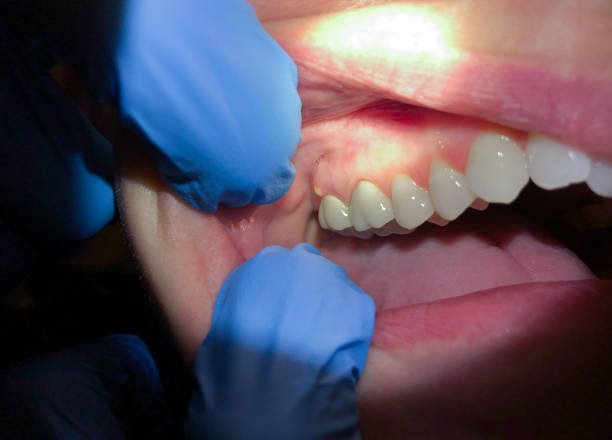Best Broken or Cracked Tooth Emergency Dentist in Wheaton, IL